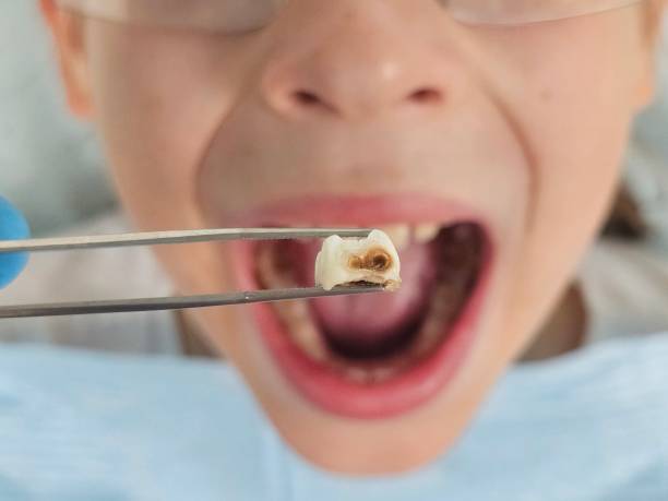 Best Emergency Wisdom Teeth Removal in Atlanta, GA
