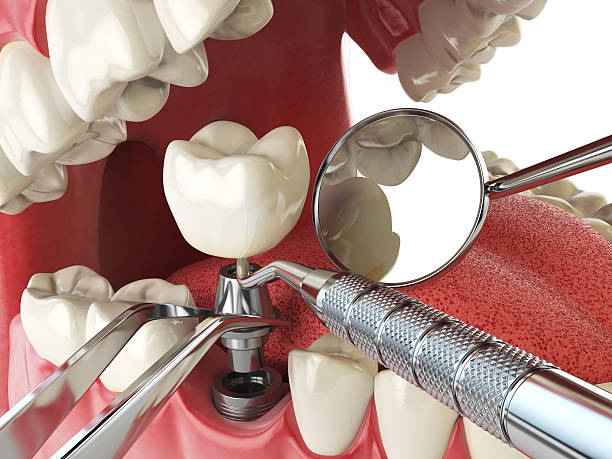 Best Emergency Denture Repair in Atlanta, GA
